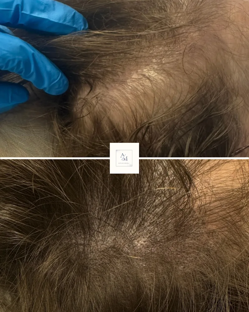 AM EPIDERMA | Tricopigmentation à Orléans - Épilation Orléans - OneBooking